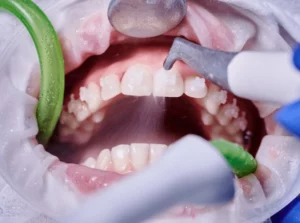 profilaxis dental