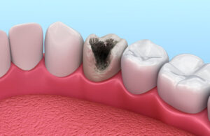 Pulpitis Dental