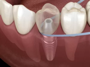limpiar implantes dentales